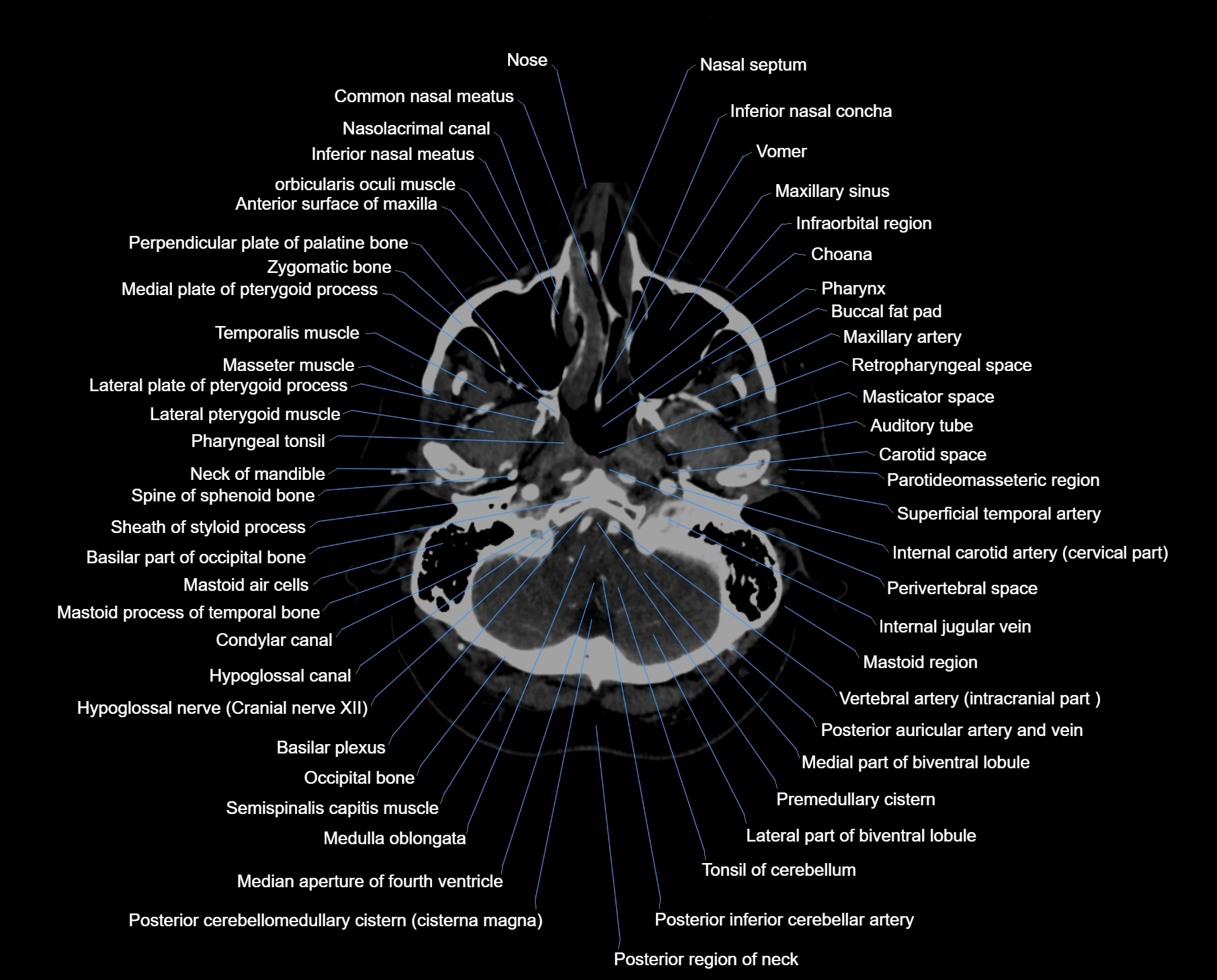 CT scan brain axial labelled cross sectional anatomy image-img-00007.webp